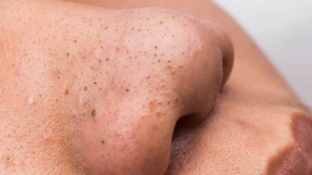 blackheads