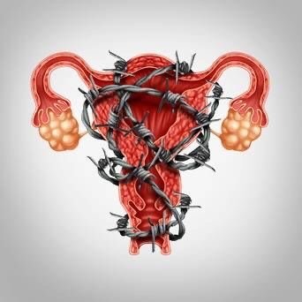 Endometriosis