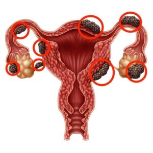 Endometriosis